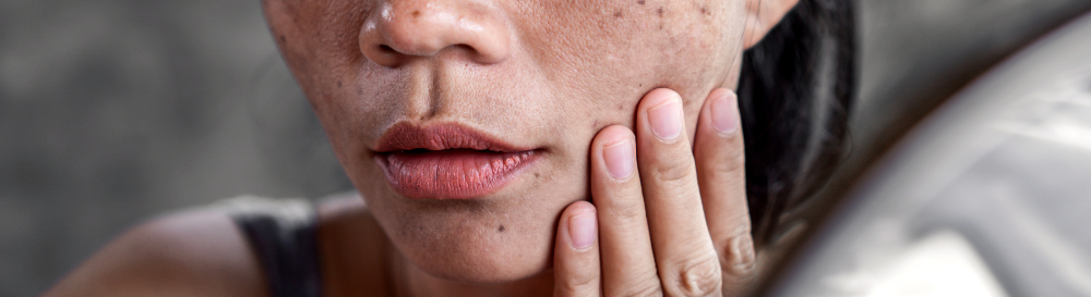 Clarear, uniformizar ou tratar? Entenda o que o seu cuidado anti-manchas realmente faz